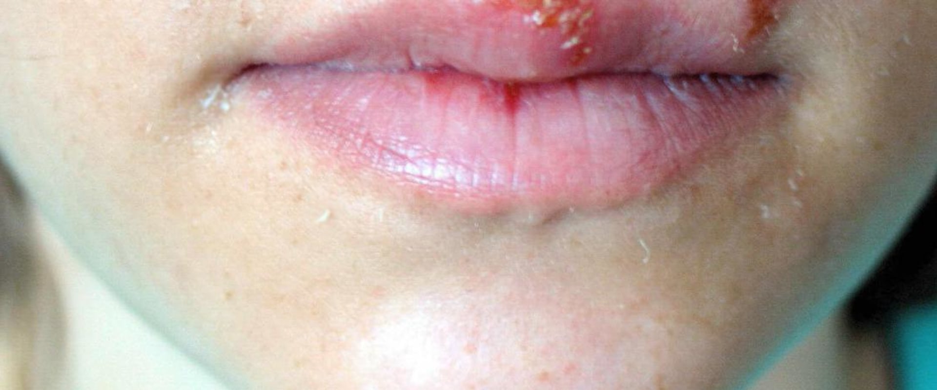 Is Herpes Curable on the Mouth?