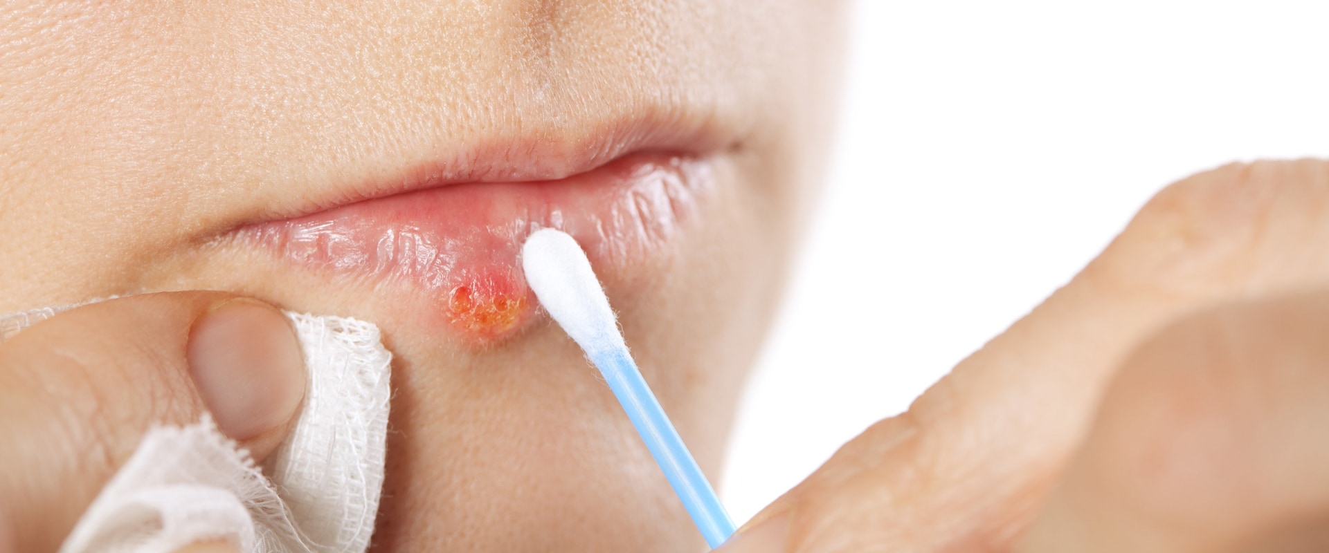 Are cold sores curable?