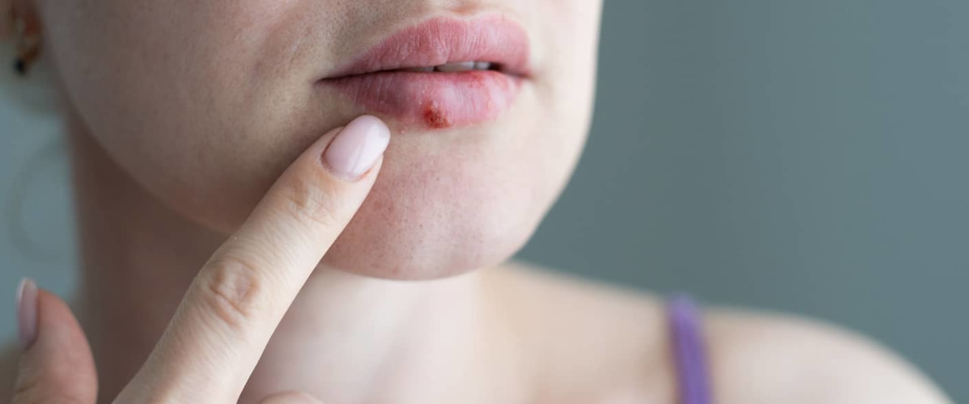 How Long Does Herpes Take to Heal?