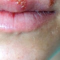 Is Herpes Curable? Understanding the Facts