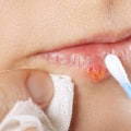 Are cold sores curable?