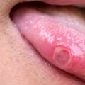 Can We Cure Herpes? Exploring the Possibilities