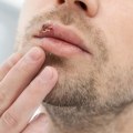Can Herpes Be Cured? An Expert's Perspective