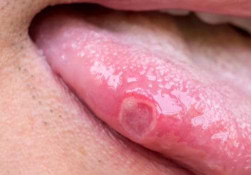 Can We Cure Herpes? Exploring the Possibilities