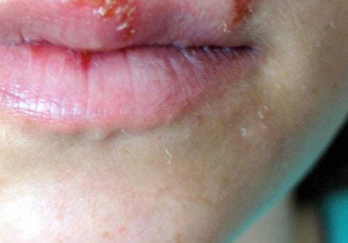 When is the Best Time to Treat Herpes?