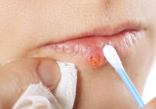 How to Treat Cold Sores: Natural Remedies and Medications