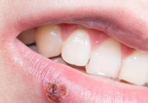 Can You Cure Herpes on the Lips?