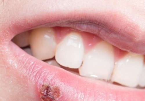 How to Treat Herpes on Lips: A Comprehensive Guide