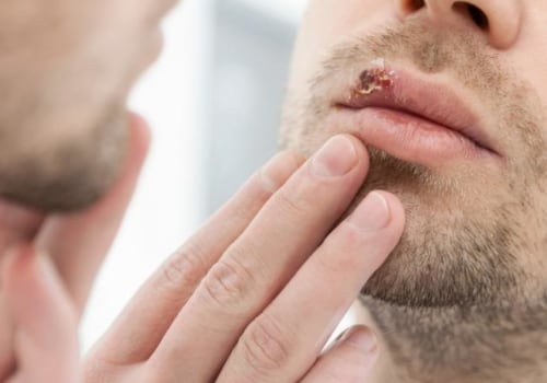 Is a Herpes Cure on the Horizon?